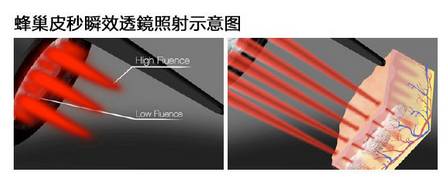 皮秒祛斑后遗症,皮秒激光祛斑仪