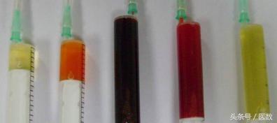 膝盖积水什么颜色,病就是什么样的