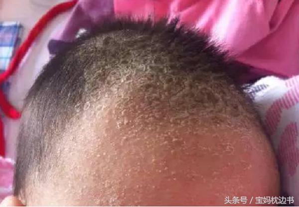 粟粒疹和湿疹有什么区别,宝宝湿疹丘疹