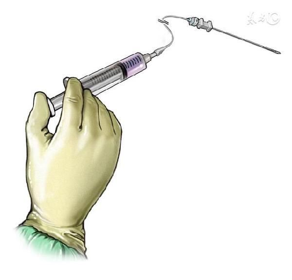 骶管注射药物治疗,骶管注射疗法治疗腰腿痛