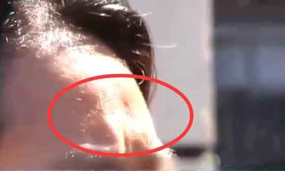 经常做超声刀副作用,超声刀面部提拉副作用