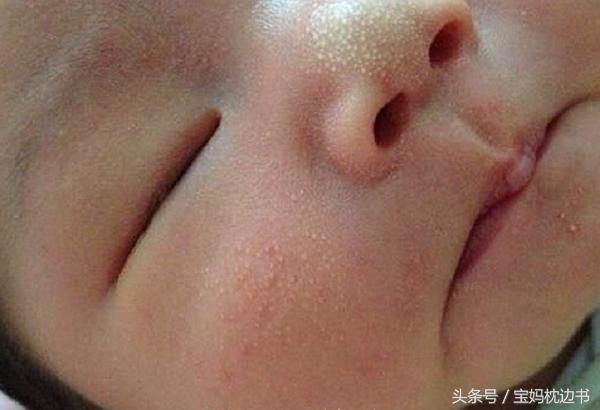 粟粒疹和湿疹有什么区别,宝宝湿疹丘疹