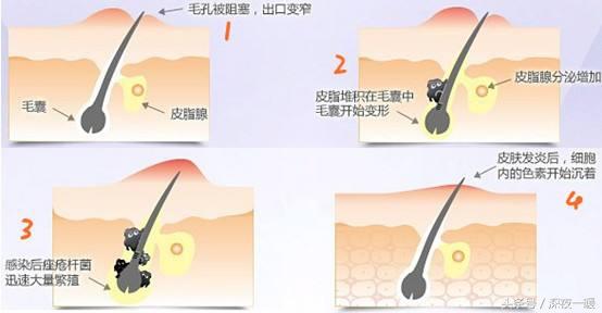 祛痘好方法更快更有效,祛痘最真实的方法