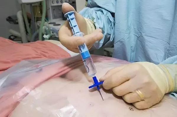 净瞎说！穿刺活检会诱发肿瘤转移，不敢做啊？