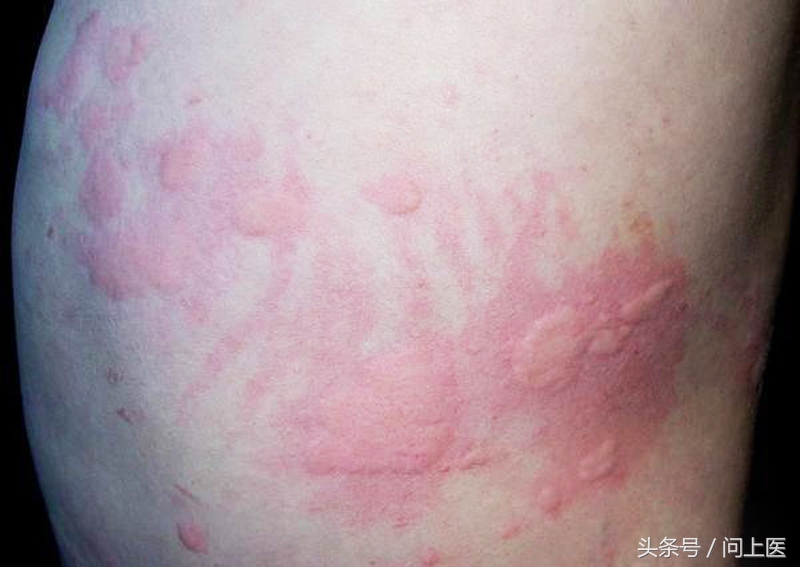 麻疹会传染吗是什么原因形成的,麻疹一定会传染给别人吗