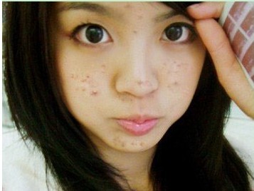 长红肿的痘痘怎么办,女孩鼻子上长痘痘怎么办
