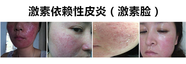 激素脸到底怎么解决,激素脸真的有必要排毒吗