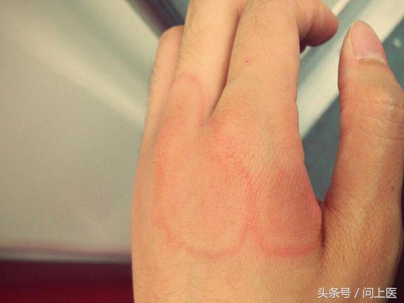 麻疹会传染吗是什么原因形成的,麻疹一定会传染给别人吗