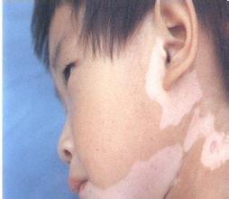 白癜风丸可以不让白癜风扩散吗,如何防止白癜风扩散应该怎么做