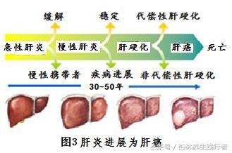 28岁小伙因为肝癌腹大如鼓,主任说太难治了!竟是这3点造成!