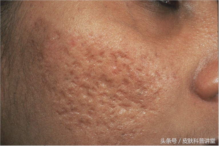 痘印痘痕怎么治,痘印和痘疤怎么治疗最好