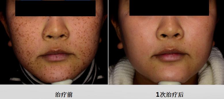 皮秒祛斑后遗症,皮秒激光祛斑仪