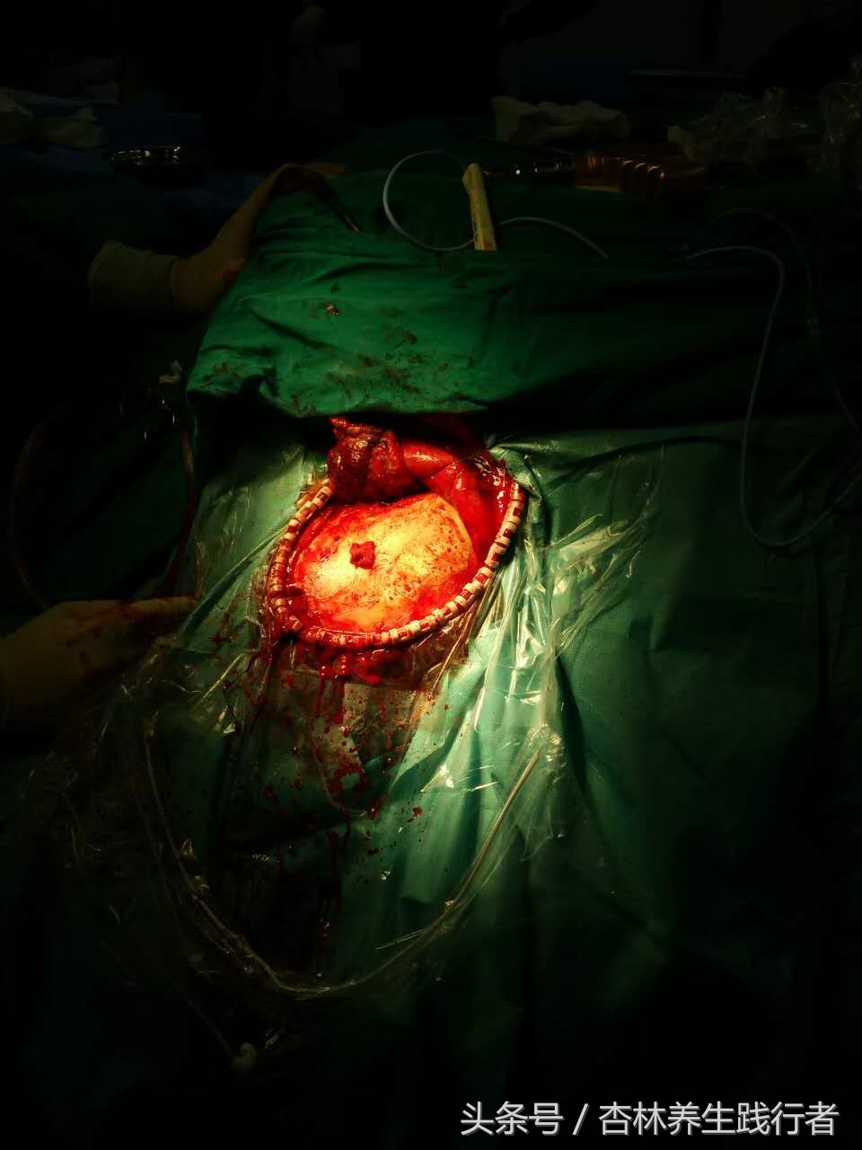 脑出血做开颅手术能活多少年,脑出血开颅手术以后能活多少年