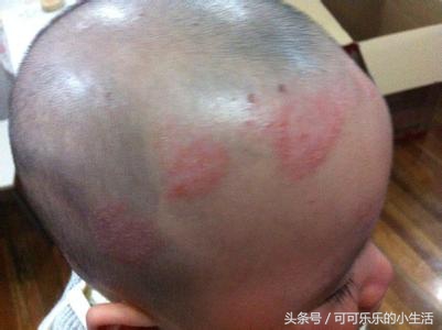 慢性湿疹会终生不愈吗,婴儿湿疹怎么办三个妙招来解决