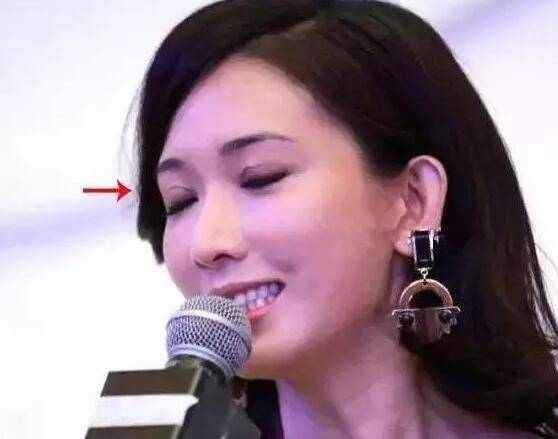 双眼皮手术该如何避免长期疤痕肉条不消肿?