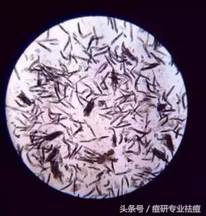 长痘上密密麻麻的虫子是什么,痘痘里面的虫子是什么