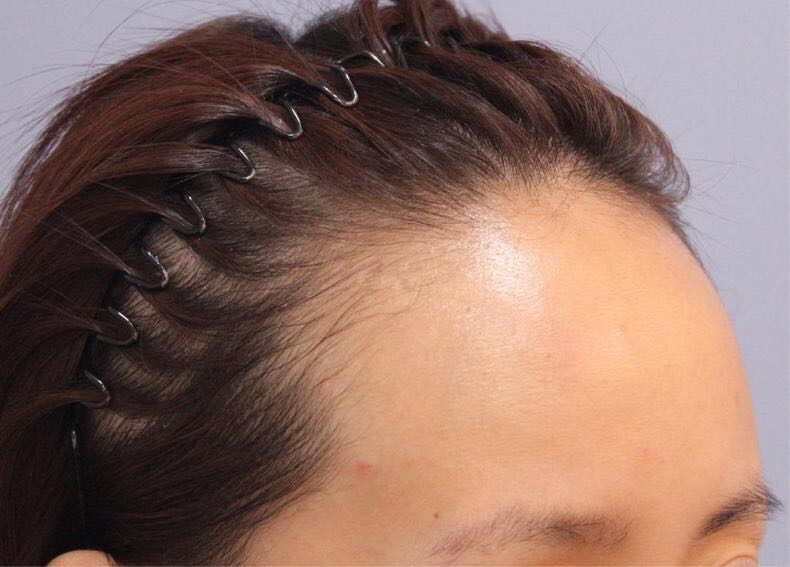 防止发际线后移习惯,让发际线前移的习惯