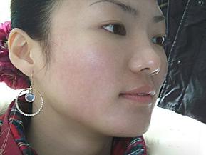 战痘的小秘诀,战痘的血泪史完整版