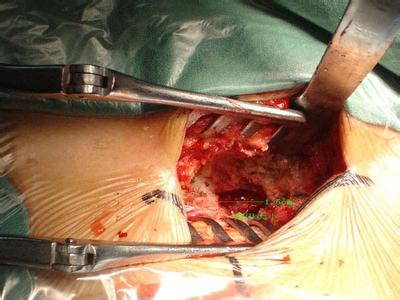 骨刺或者骨质增生能动手术去除吗,骨刺和骨质增生都做什么样的手术