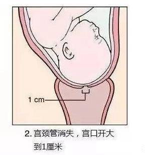 生娃打开宫口的流程,孕妇宫口开1指到生需要多久