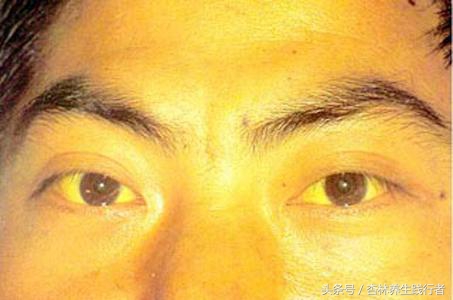 28岁小伙因为肝癌腹大如鼓,主任说太难治了!竟是这3点造成!