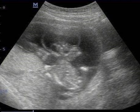 28岁孕妇产检草草了事，怀孕30周被检查出胎儿无脑！