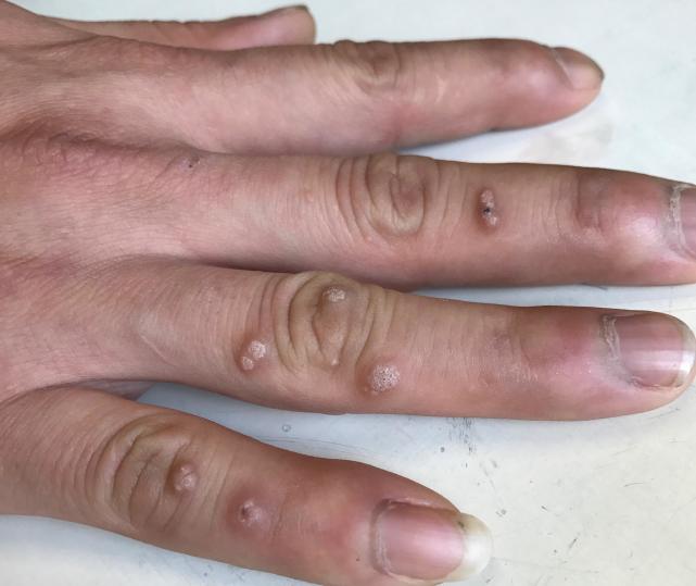 手上出来的瘊子怎么能治好,手上的瘊子怎么能根除