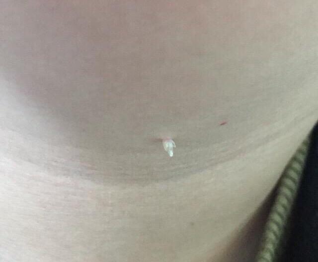 手上出来的瘊子怎么能治好,手上的瘊子怎么能根除