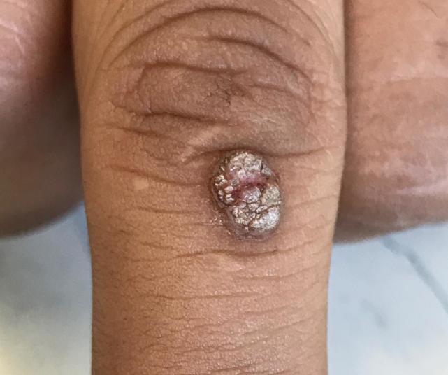 手上出来的瘊子怎么能治好,手上的瘊子怎么能根除