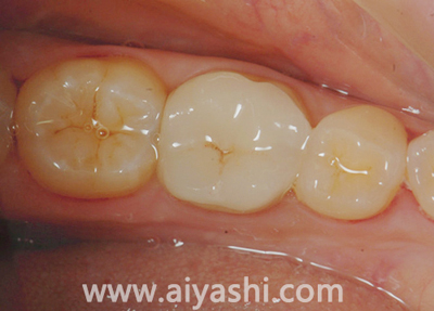 中年牙缝越来越大是什么原因,门牙缝越来越大是什么导致的