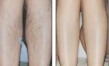 入夏前脱毛,最好用的脱毛小技巧是什么