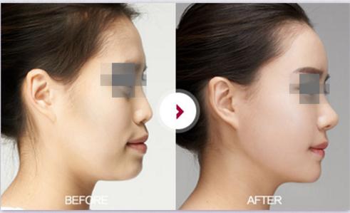 蒜头鼻鼻基底凹陷嘴凸,蒜头鼻和鹰钩鼻图片