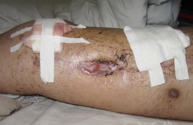 骨髓炎手术感染怎么办,中医治疗骨折方法