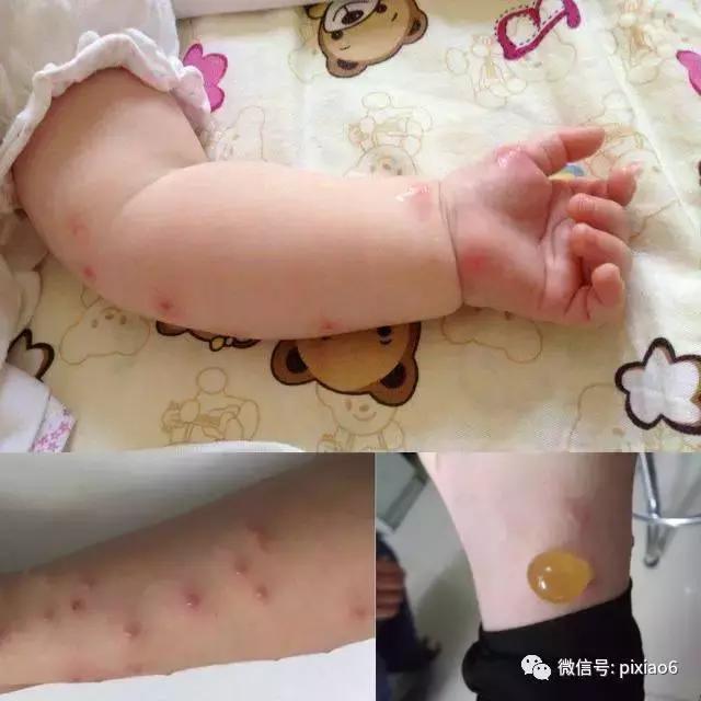 奇痒无比一抓就起水泡,浑身刺痒一挠全是小水泡