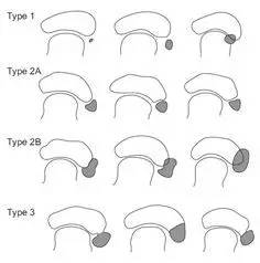 踝关节疼痛病因病机,踝关节伤病