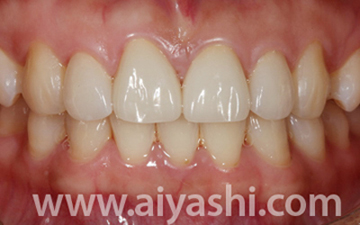 中年牙缝越来越大是什么原因,门牙缝越来越大是什么导致的