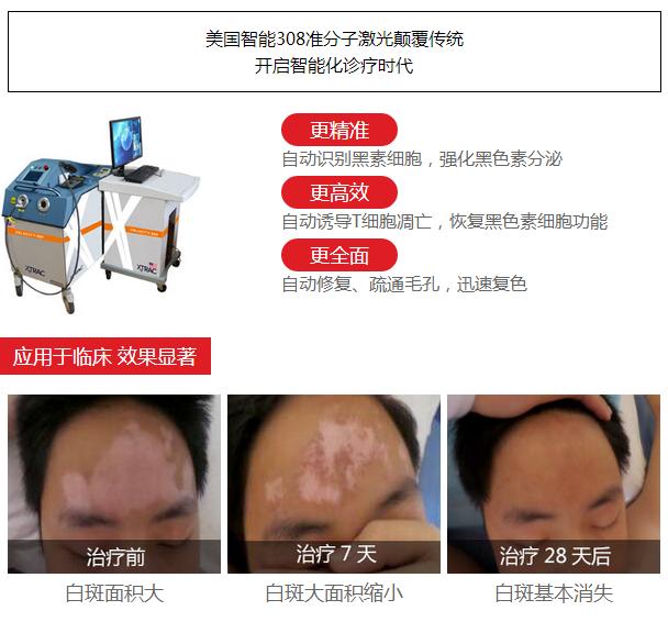 308纳米治白癜风原理,308消除白斑