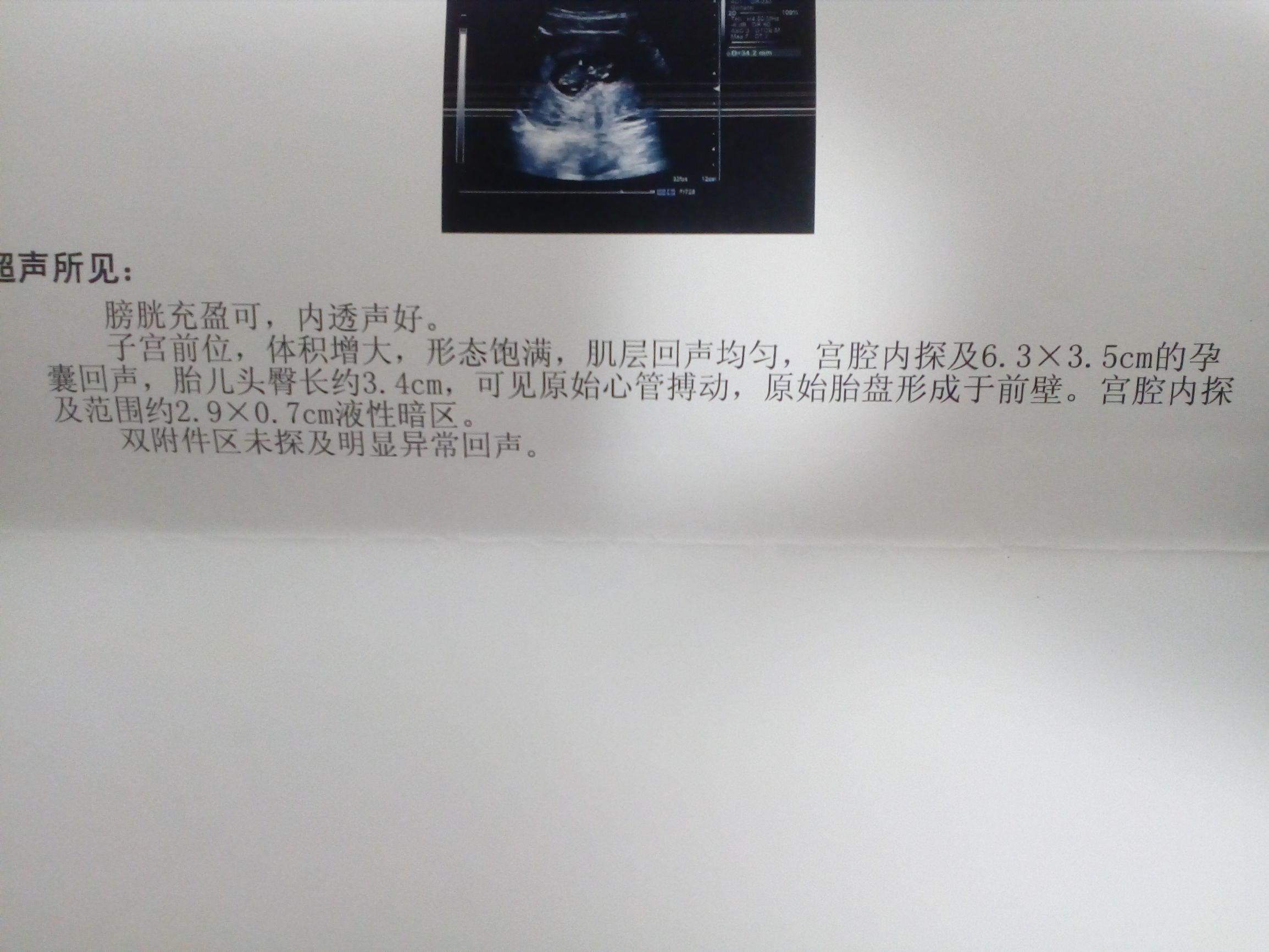 先兆流产，宫腔积液，宫颈口分离，保胎那些事