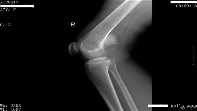 骨肉瘤常见还是骨转移瘤常见,骨瘤和骨肉瘤的区别