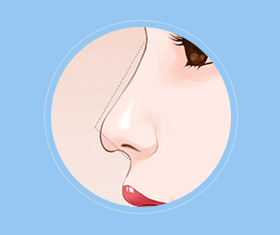 蒜头鼻鼻基底凹陷嘴凸,蒜头鼻和鹰钩鼻图片