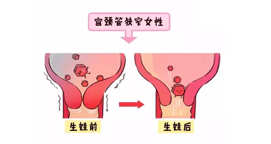 少女痛经，结婚生娃之后就好了？