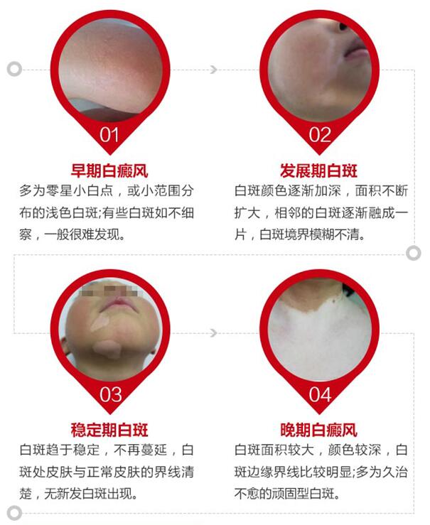 微科普——白癜风疾病的诊断标准