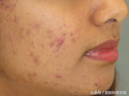 痘印痘痕怎么治,痘印和痘疤怎么治疗最好