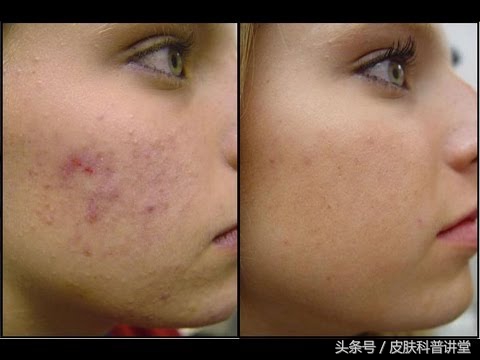 痘印痘痕怎么治,痘印和痘疤怎么治疗最好