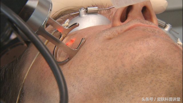 痘印痘痕怎么治,痘印和痘疤怎么治疗最好