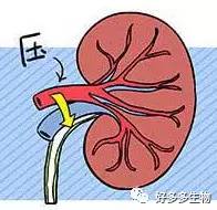 肾积水——尿都堵了，肾怎么能好