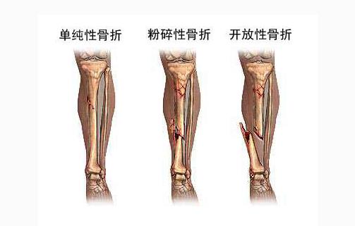骨髓炎手术感染怎么办,中医治疗骨折方法