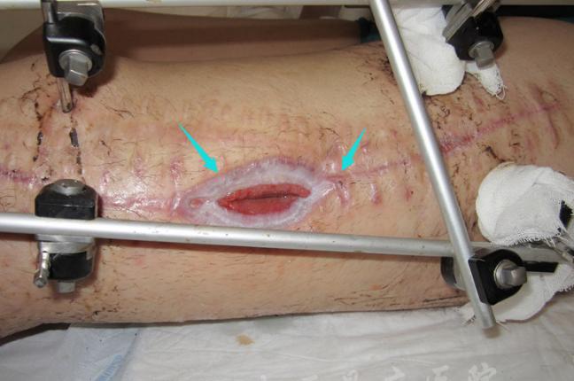 骨髓炎手术感染怎么办,中医治疗骨折方法