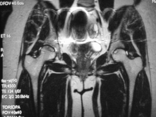 早期股骨头坏死核磁共振能看到吗,股骨头坏死修复过程的磁共振表现