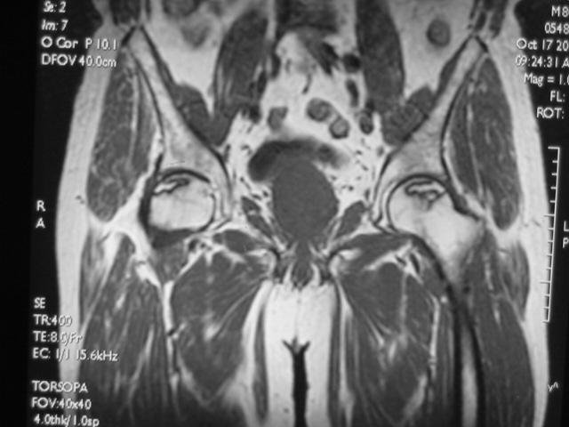 早期股骨头坏死核磁共振能看到吗,股骨头坏死修复过程的磁共振表现